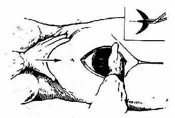 一手伸入宫腔带儿头,另一手在宫底按压帮助娩出。