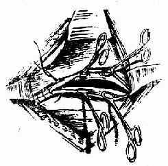 环钳夹子宫切口两缘,间断缝合切口里层