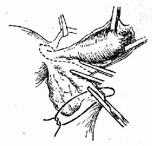 紧挨输卵管钳夹,以免影响卵巢血运