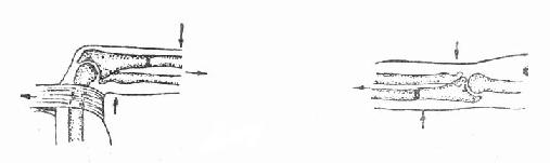 尺骨上1/3骨折合并桡骨头脱位正复法