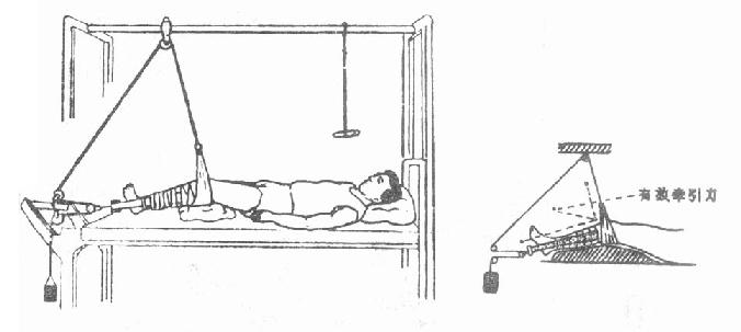 动滑车皮肤牵引法(Russell氏法)