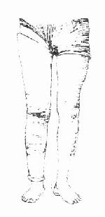 半月板损伤解除“交锁”后,长腿石膏固定