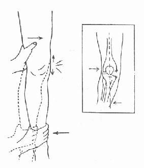侧压试验:内侧副韧带 完全断裂,有异常外展活动度