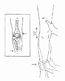 侧压试验:外侧副韧带 完全断裂,有异常内收活动度