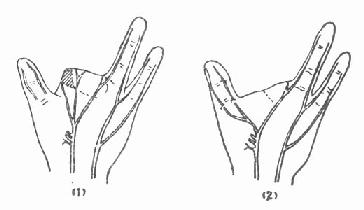 转移手指残余神经,吻合拇指两神经