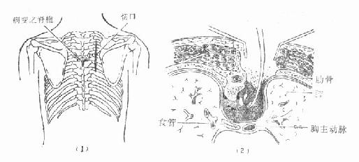 胸椎结核,肋骨横突切除及病灶清除术