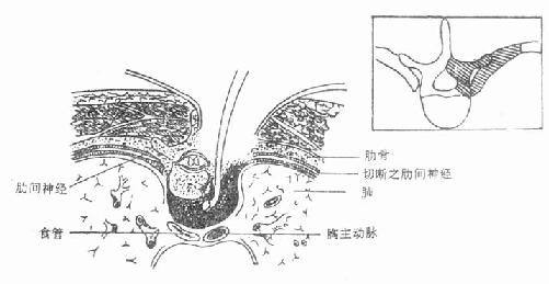 胸椎结核合并截瘫,前外侧病灶清除及减压术。