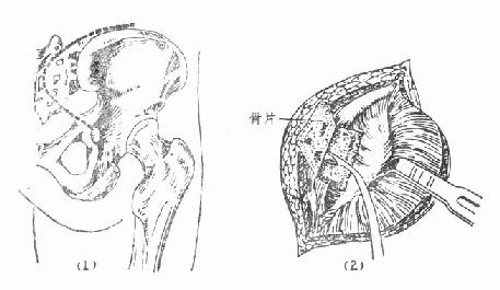 骶髂关节结核病灶清除术,后显露法