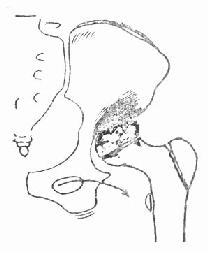 髋关节结核,股骨头及髋臼破坏