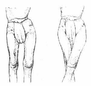 髋关节骨内收挛缩