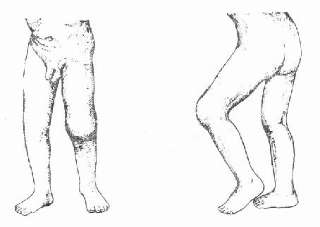 左膝关节结核,关节肿胀及屈曲挛缩