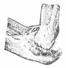 肘关节结核,有广泛破坏及缺损