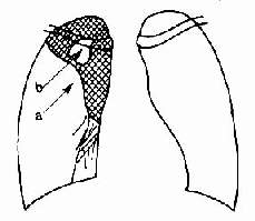 右肺上叶肺癌合并肺不张 下缘呈“S”形(a)肺涨中有坏死空洞(b)