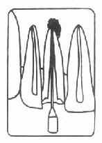 牙折并发慢性尖周炎(根管内有根管治疗器械)