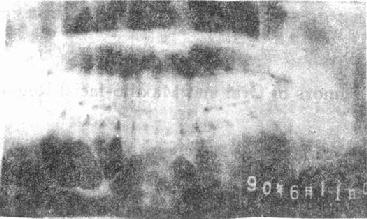 X片示:造釉细胞瘤(下颌体部)