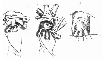 根肝静脉整形,形成共同开口