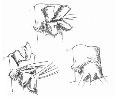 缝扎肝右静脉,肝左、肝中静脉形成共同开口