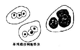 病毒感染时,痰涂片中的细胞内包涵体