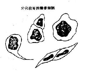 高分化鳞癌与鳞状化生, 核异质细胞鉴别示意图