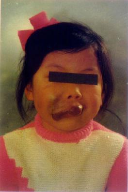 口腔(颜面)巨大血管瘤术前