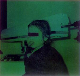 口腔(颜面)巨大血管瘤术前