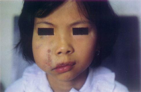 口腔(颜面)巨大血管瘤Nd:YAg laser术后照