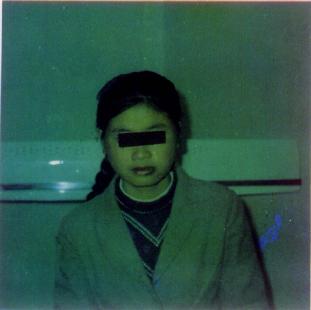 口腔内(下唇及颊部)巨大血管瘤术后