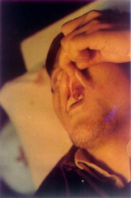 口腔鳞癌(上颌)