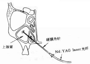 Nd:YAG laser穿刺术