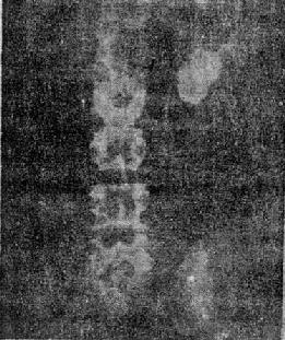 左肾结核钙化(平片)