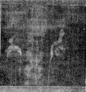 左肾结核(逆行造影)