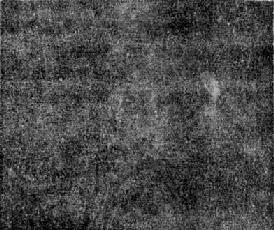 右肾结核(I、V、C)