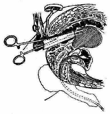 抽得脓液后穿刺暂不拔出,用刀尖沿穿刺方向切开再用止血钳插入脓腔撑开止血钳扩大引流口。