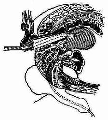 软皮橡管放入脓腔内,从肛门引出