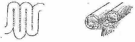 小肠折叠排列术(Noble法)