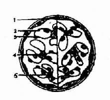 左侧为正常肾小球模式图,右侧为局灶性增殖性肾小球肾炎,部分系膜区系膜细胞和基质增生