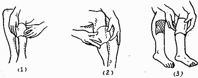 皮瓣逆行设计的步骤(试样)