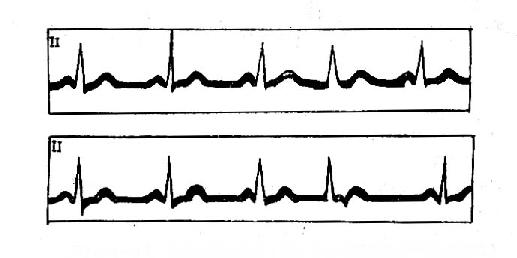 交界性期前收缩(逆行P波与期前的QRS波相重迭)