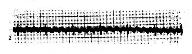 心房扑动(呈4:1传导)心室律规则