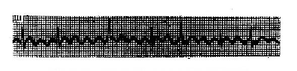 心房扑动(呈4:1至2:1不等)心室率不规则