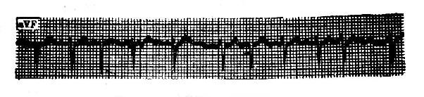 心房纤颤(心室率较快)