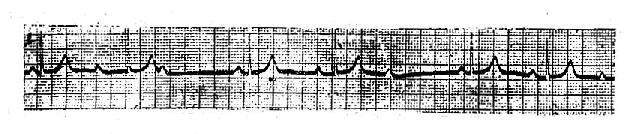 Ⅱ度Ⅰ型房室传导阻滞,3:2房室传导