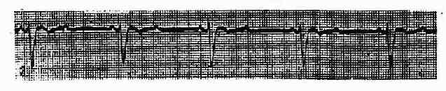 Ⅱ度Ⅱ型房室传导阻滞(莫氏Ⅱ型)