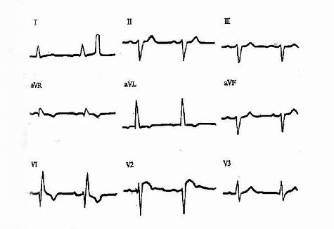 双束支传导阻滞(完全性右束支伴左前分支阻滞)