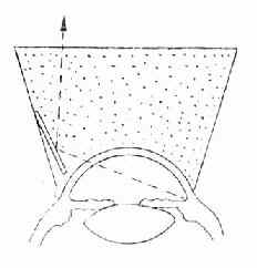 间接房角镜(反射式)