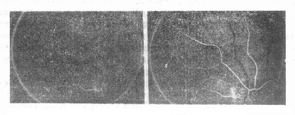 动脉早期荧光造影,显示视网膜睫状血管动脉期