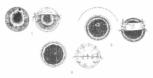 三种不同部位的角膜溃疡,采取不同的结膜瓣遮盖法