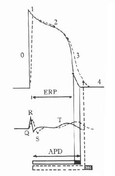 奎尼丁对心室肌动作电位、单极电图(中)及ERP、APD影响的模式图
