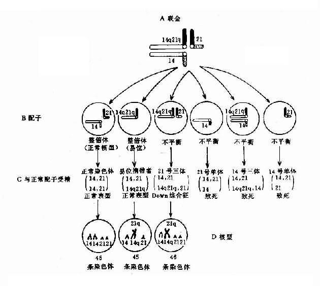 罗氏易位(14q21q)杂合体减数分裂时染色体的联会