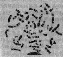 Ph染色体示 9;22易位(9q34;22q11);→fi 22q-;▲示9+(晏炬提供)